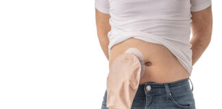 colostomy bag